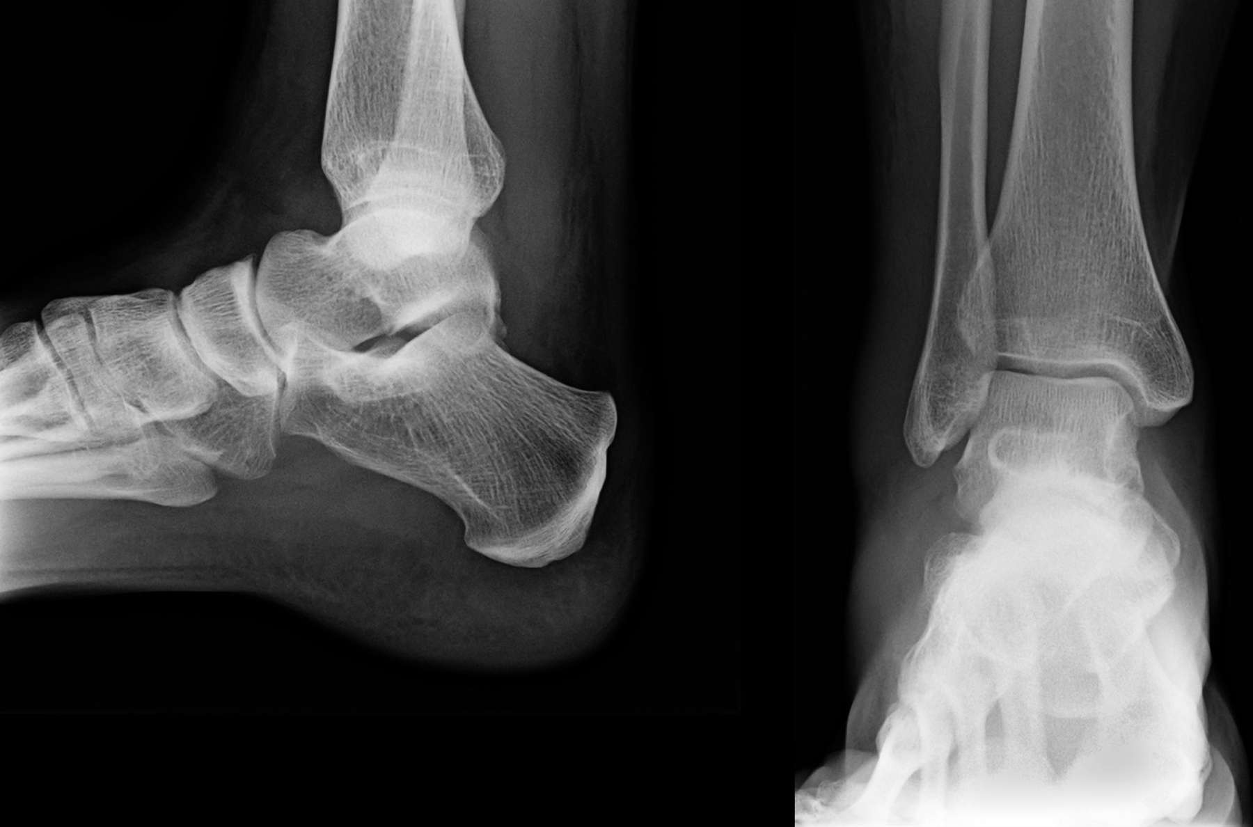 sprained ankle x ray
